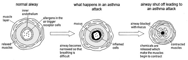 diagram showing narrowing airways in asthma attack